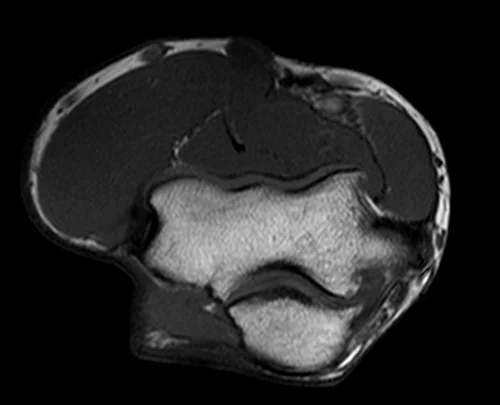 mri elbow axial t1 image 2 - MRI