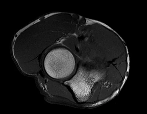 mri elbow axial t1 image 3 - MRI