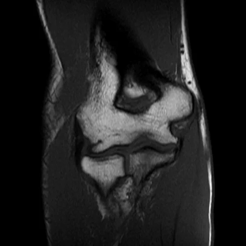 mri elbow coronal t1 image 2 - MRI