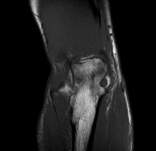mri elbow coronal t1 image 3 - MRI