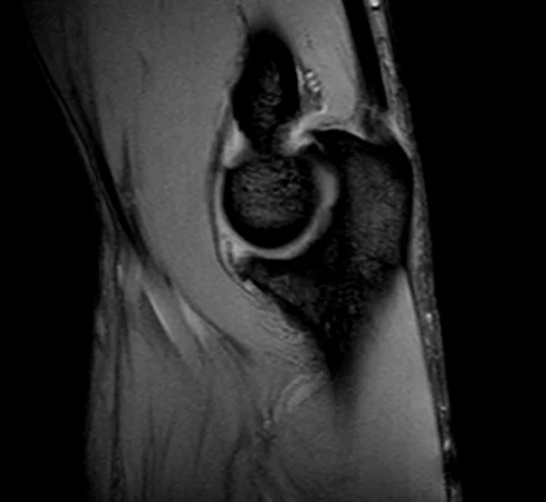 mri elbow sagittal medic image 1 - MRI