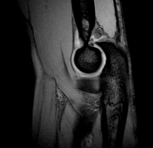 mri elbow sagittal medic image 2 - MRI