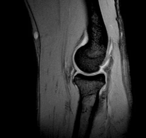 mri elbow sagittal medic image 3 - MRI