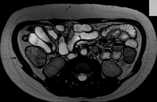 mri enteroclysis axial trufi image 1 - MRI