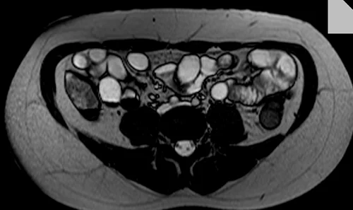 mri enteroclysis axial trufi image 2 - MRI
