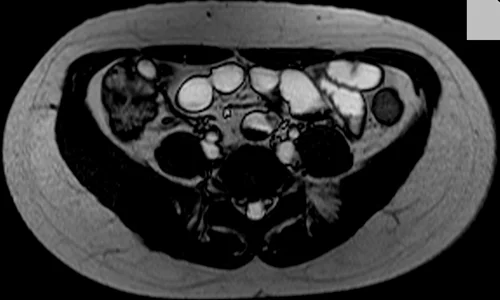 mri enteroclysis axial trufi image 3 - MRI