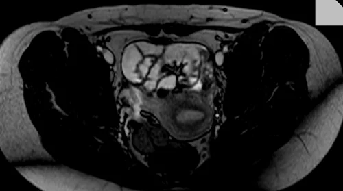 mri enteroclysis axial trufi image 4 - MRI
