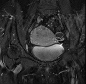 MRI endometrial cancers T1 fat sat post contrast images