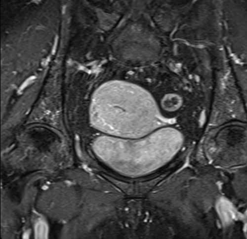 MRI endometrial cancers T1 fat sat post contrast images