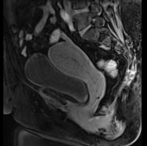 mri female pelvis (gynecology ) sagittal t1 flash dynamic post contrast 1 - MRI