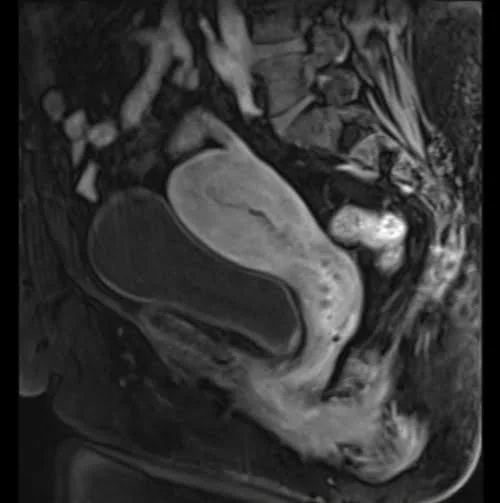 mri female pelvis (gynecology ) sagittal t1 flash dynamic post contrast 3 - MRI