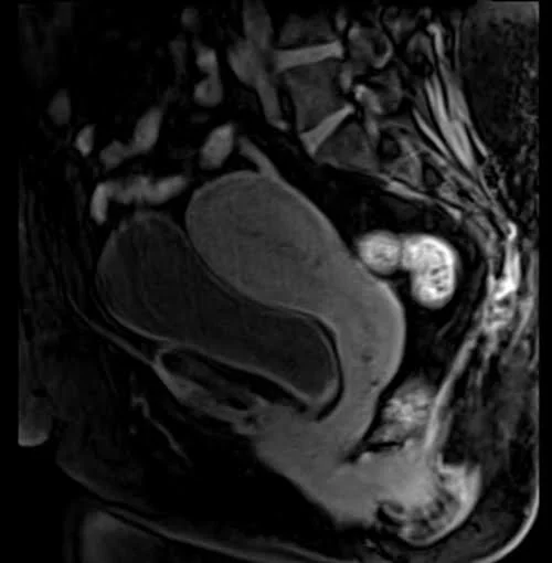 mri female pelvis (gynecology ) sagittal t1 flash dynamic pre contrast - MRI