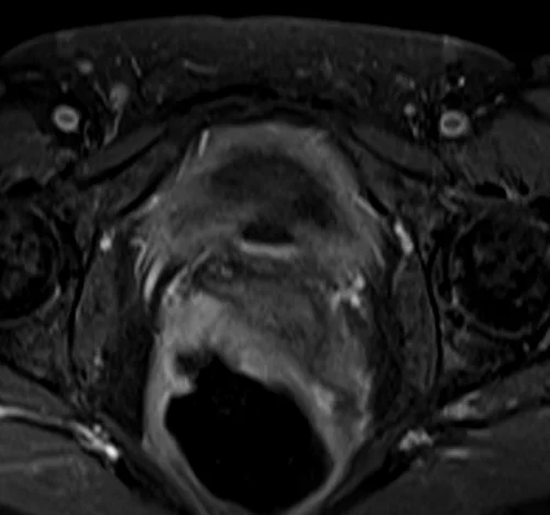 mri female urethra axial t1 fat sat post contrast image 1 - MRI