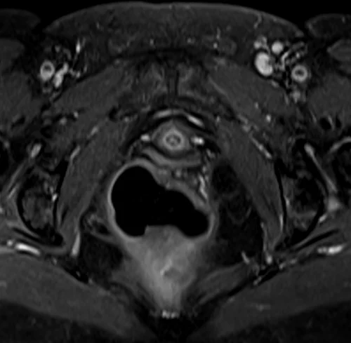 mri female urethra axial t1 fat sat post contrast image 2 - MRI