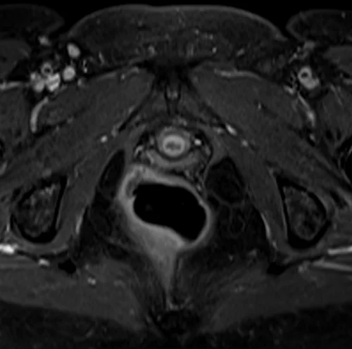 mri female urethra axial t1 fat sat post contrast image 3 - MRI