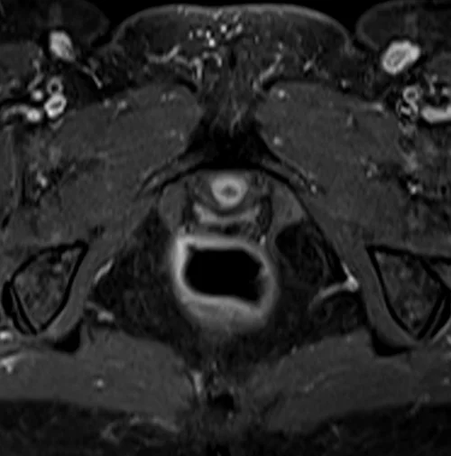 mri female urethra axial t1 fat sat post contrast image 4 - MRI
