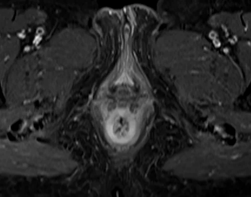 mri female urethra axial t1 fat sat post contrast image 6 - MRI