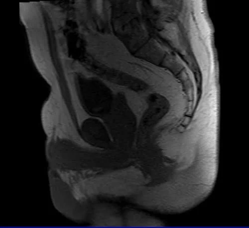 mri fistula localizer image 1 - MRI