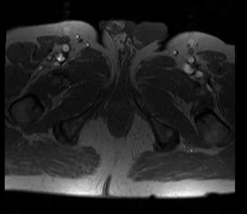 mri fistula localizer image 3 - MRI
