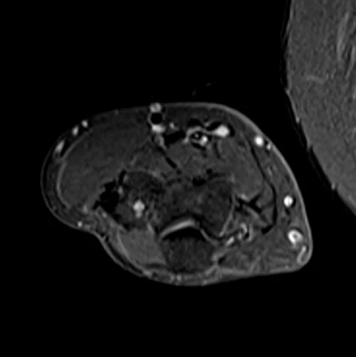 mri fore arm axial stir image 1 - MRI