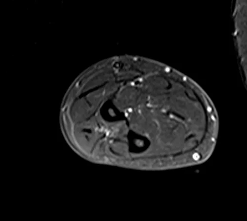 mri fore arm axial stir image 2 - MRI