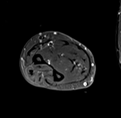mri fore arm axial stir image 3 - MRI
