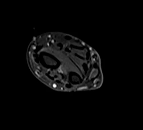 mri fore arm axial stir image 4 - MRI