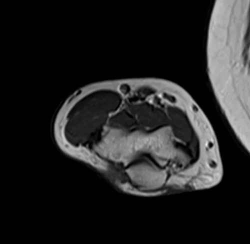 mri fore arm axial t1 image 1 - MRI