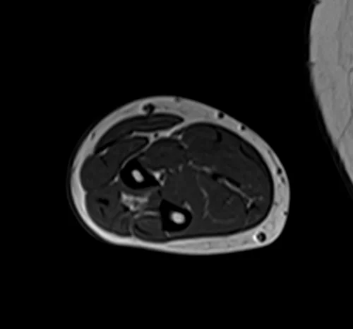 mri fore arm axial t1 image 2 - MRI