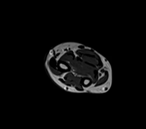 mri fore arm axial t1 image 4 - MRI