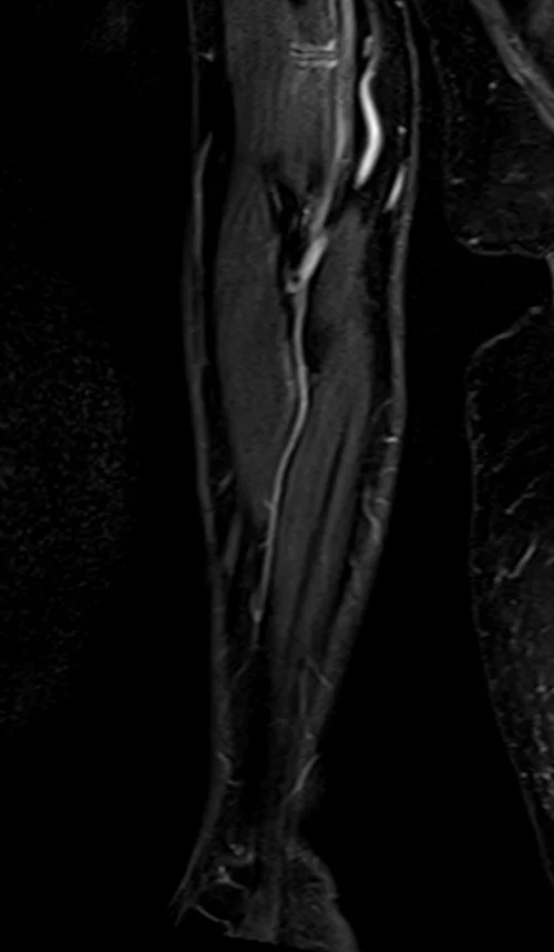 mri fore arm coronal stir image 1 - MRI