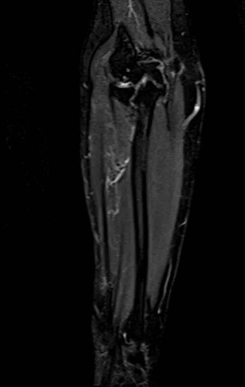 mri fore arm coronal stir image 3 - MRI