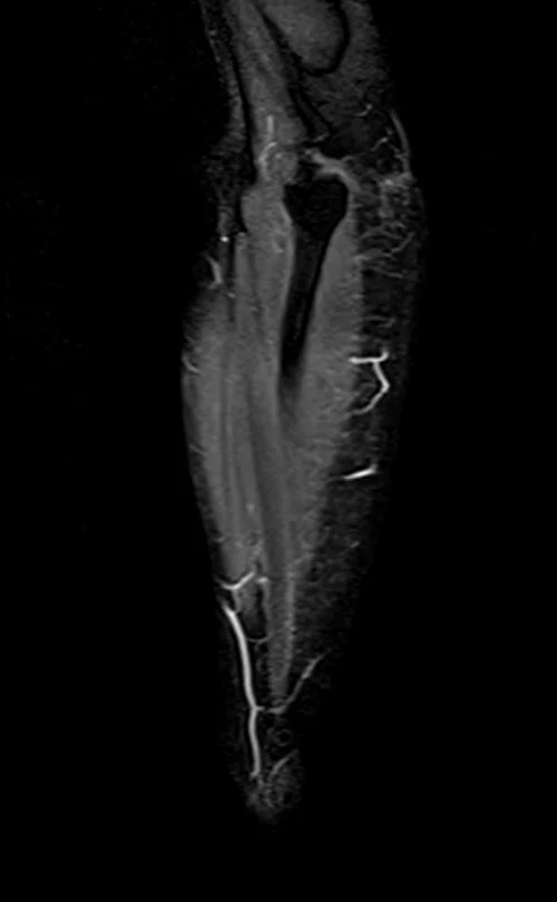 mri fore arm coronal stir image 4 - MRI