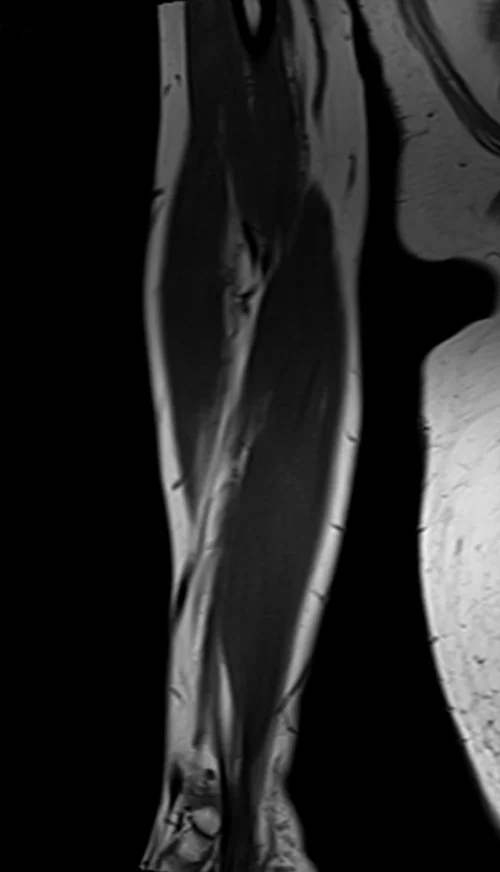 mri fore arm coronal t1 image 1 - MRI