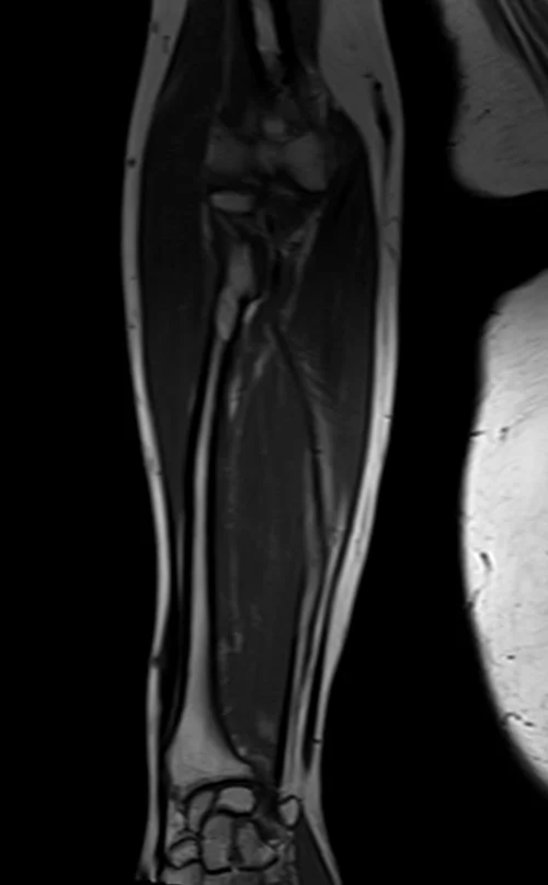 mri fore arm coronal t1 image 2 - MRI