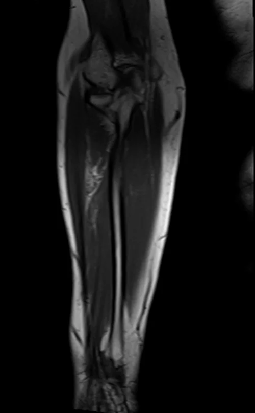 mri fore arm coronal t1 image 3 - MRI