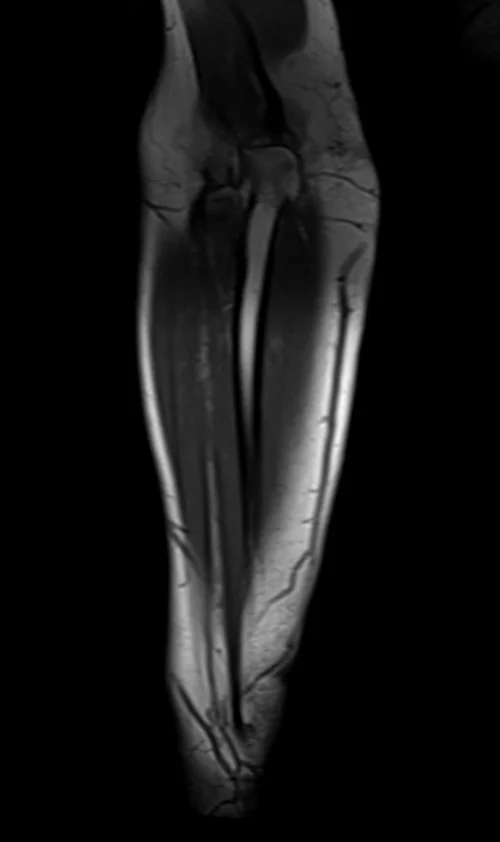 mri fore arm coronal t1 image 4 - MRI