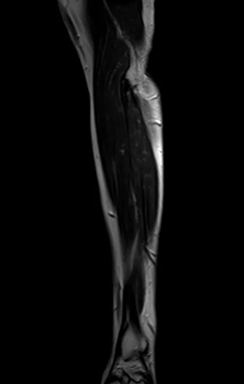 mri fore arm sagittal t2 image 1 - MRI