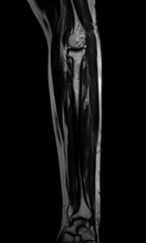 mri fore arm sagittal t2 image 2 - MRI