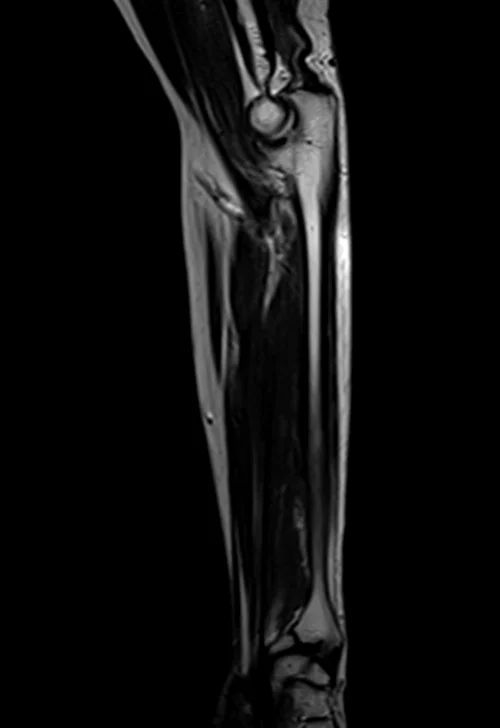 mri fore arm sagittal t2 image 3 - MRI
