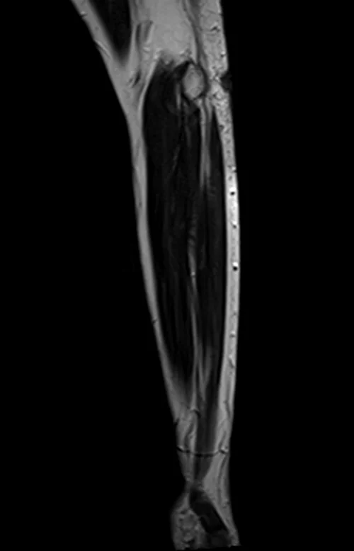 mri fore arm sagittal t2 image 4 - MRI