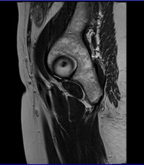mri hips sag t2 image 1 - MRI
