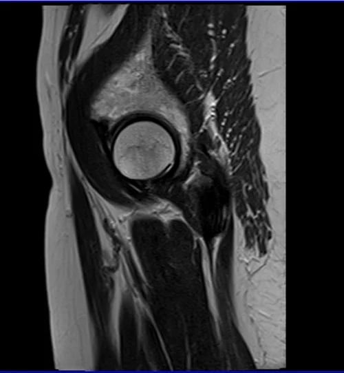 mri hips sag t2 image 2 - MRI