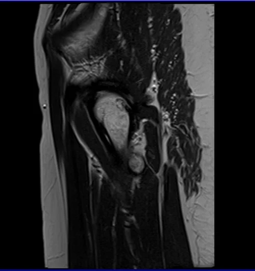 mri hips sag t2 image 3 - MRI