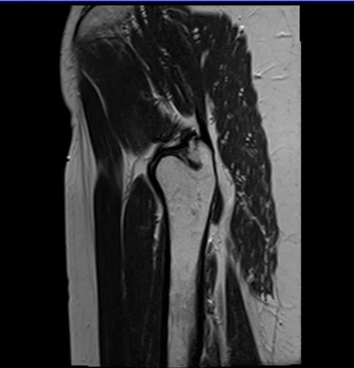 mri hips sag t2 image 4 - MRI