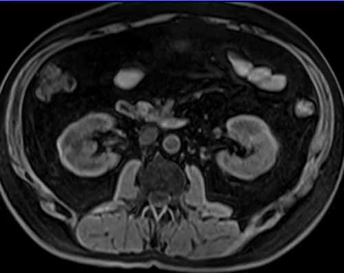 mri kidneys axial t1 2 - MRI
