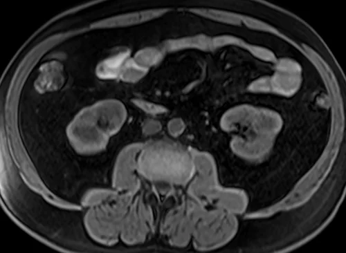 mri kidneys axial t1 3 - MRI