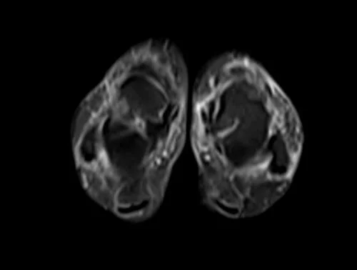 mri lower legs (calves) stir axial image 1 - MRI