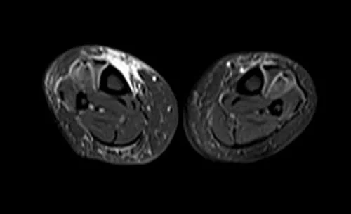 mri lower legs (calves) stir axial image 2 - MRI