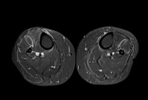 mri lower legs (calves) stir axial image 3 - MRI
